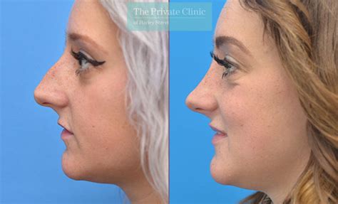 nose shaper results|Nose Reshaping Surgery .